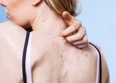 How to Prevent and Treat Back Acne (“Bacne”)?