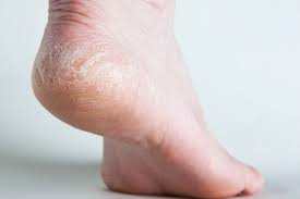 The Causes of Dry Feet and How to Treat them!