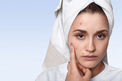 What You Should Know About Acne?